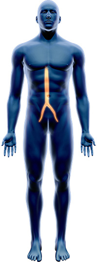 Aortic Intervention